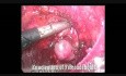 Escisión endoscópica de fibroadenoma