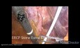 Exploración laparoscópica del CBC, técnica de extracción de cálculos mediante balón de CPRE