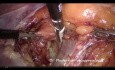 Cirugía de carcinoma de endometrio