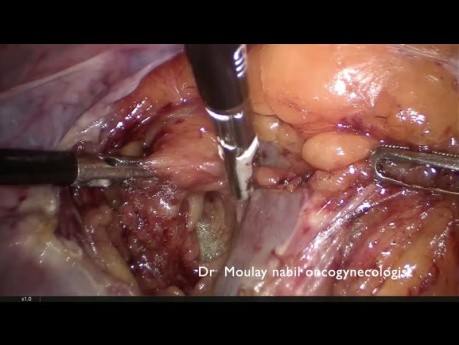 Cirugía de carcinoma de endometrio