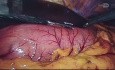 Gastrectomia total laparoscopica D2
