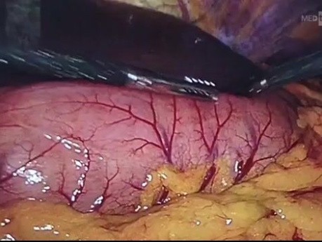 Gastrectomia total laparoscopica D2