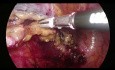 Hemicolectomía izquierda extendida laparoscópica (procedimiento Deloyers)