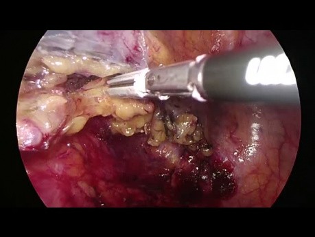 Hemicolectomía izquierda extendida laparoscópica (procedimiento Deloyers)