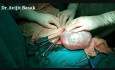 Cirugía de quiste grande de ovario
