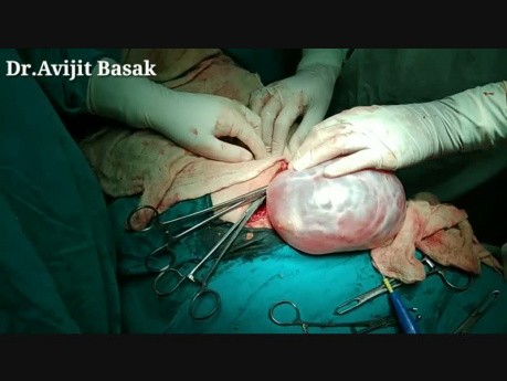 Cirugía de quiste grande de ovario