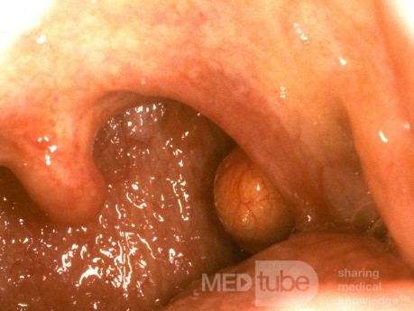 Amígdalas del quiste mucoso benigno