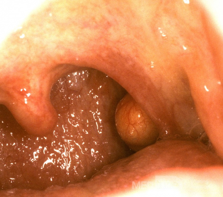 Amígdalas del quiste mucoso benigno