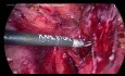 Masa anexial poshisterectomía, uréter