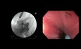 Gastroenterostomía guiada por USE
