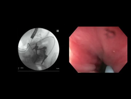 Gastroenterostomía guiada por USE