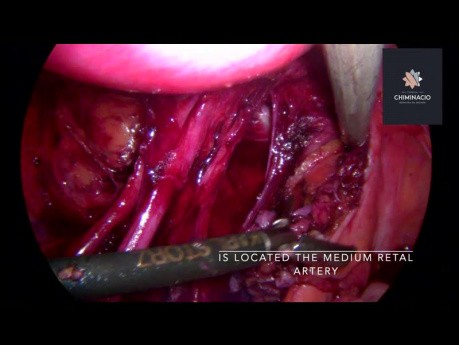 Identificación de arteria rectal media en cirugía de endometriosis 