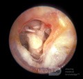 Timpanoesclerosis, mucosa del oído medio