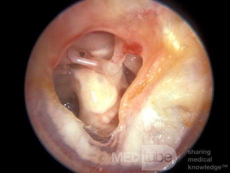 Timpanoesclerosis, mucosa del oído medio