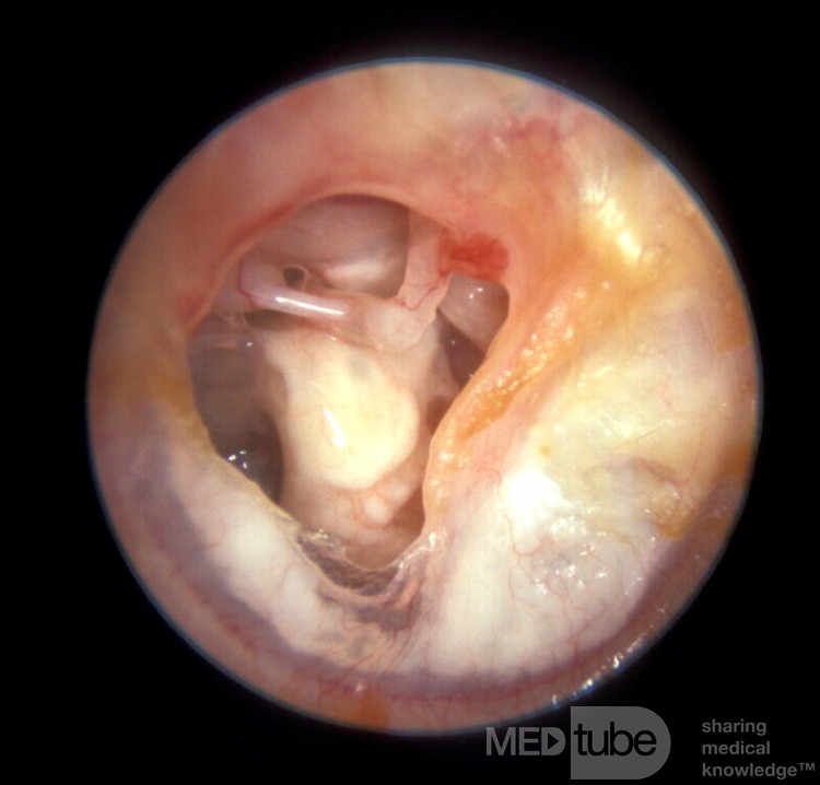 Timpanoesclerosis, mucosa del oído medio