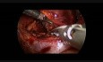 Adrenalectomía laparoscópica derecha en bebé de 9 meses