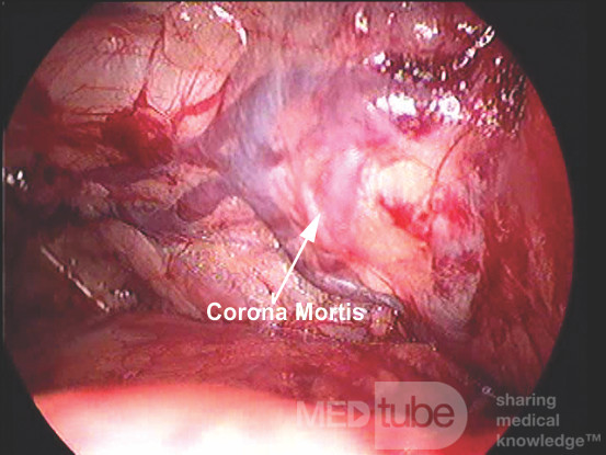 Anatomía laparoscópica de la ingle (Corona Mortis)
