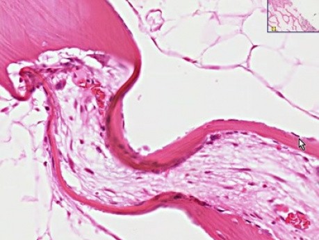 Hiperparatiroidismo - examen histopatológico - huesos