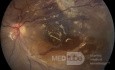 Ruptura coroidea traumática