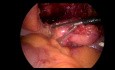 Cirugía laparoscópica de corte de tumor uracal