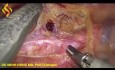 Esofagectomía toraco-laparoscópica - Parte torácica 2