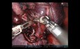 Lobectomía robótica de pulmón medio derecho