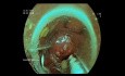 Resección endoscópica de espesor total de la base de polipectomía del colon sigmoide