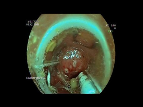 Resección endoscópica de espesor total de la base de polipectomía del colon sigmoide
