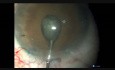Capsulorrexia - pupila pequeña