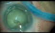 Catarata intumescente, facoemulsificación