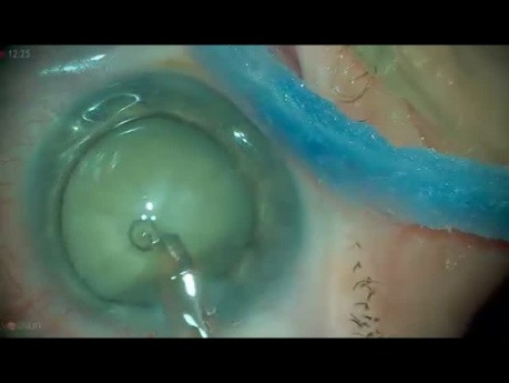 Catarata intumescente, facoemulsificación