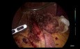 Cardiomiotomía laparoscópica de Heller + funduplicatura Dor