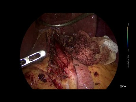 Cardiomiotomía laparoscópica de Heller + funduplicatura Dor