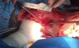 Técnica de extracción del corazón con división primero de la cavidad y luego de las venas pulmonares y finalmente de las grandes arterias