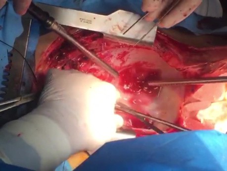 Técnica de extracción del corazón con división primero de la cavidad y luego de las venas pulmonares y finalmente de las grandes arterias