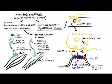 Disfagia (dificultad para tragar) - causas, fisiopatología, clasificación, investigación