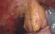 TME robótica en cáncer de recto con anastomosis ultrabaja. Velocidad 4x.