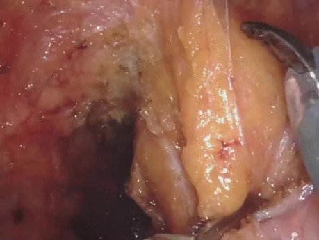 TME robótica en cáncer de recto con anastomosis ultrabaja. Velocidad 4x.