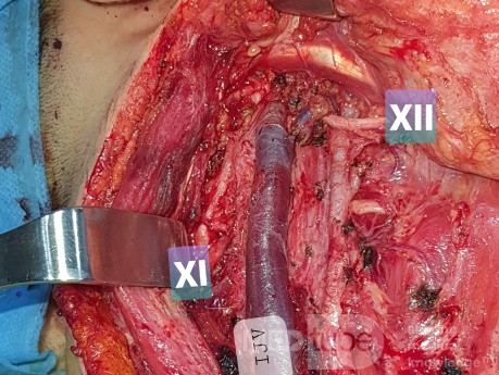 Disección selectiva de cuello para carcinoma papilar de tiroides