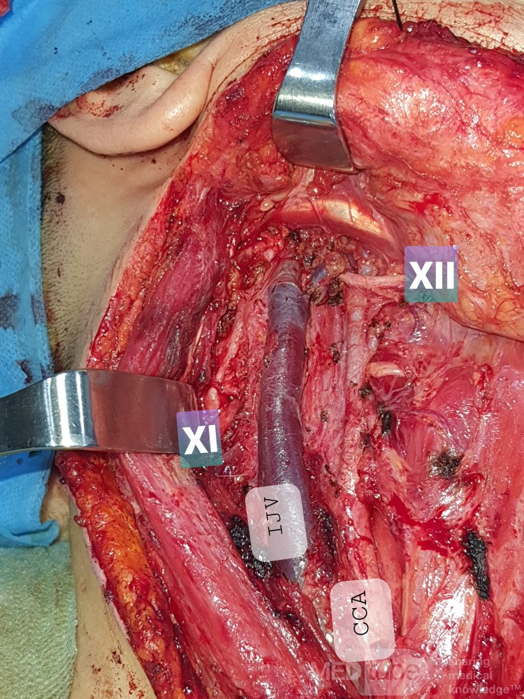 Disección selectiva de cuello para carcinoma papilar de tiroides