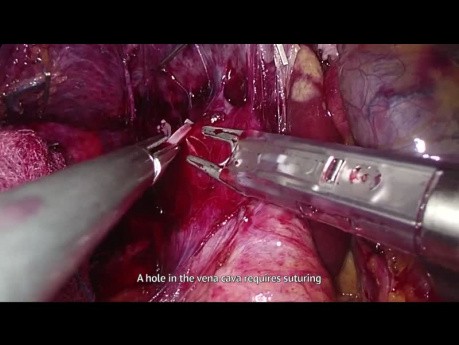 Hemihepatectomía derecha laparoscópica - sutura de la vena cava, sangrado del parénquima hepático