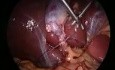 Suturar y atar en laparoscopia
