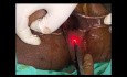 Absceso isquiorrectal con fístula anal