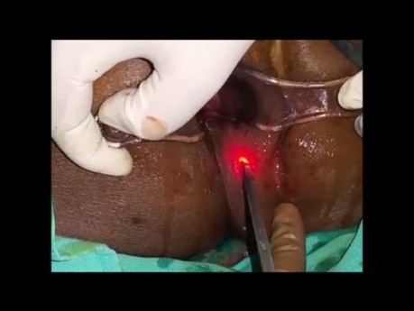 Absceso isquiorrectal con fístula anal