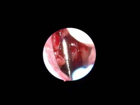 Adenotomía asistida con control endoscópico cero-óptico