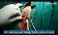Cirugía de restauración de la virginidad de himenoplastia