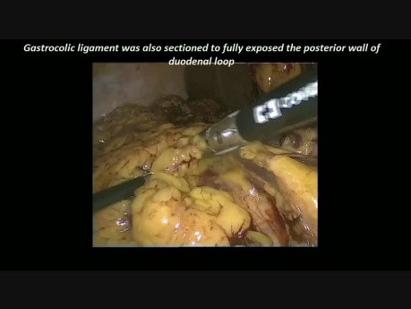Resección laparoscópica de un tumor paraaórtico localizado en la parte descendente del duodeno