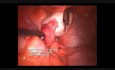 Fenestración ovárica y cromopertubación