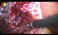 La disección del ganglio linfático Porta Hepatis puede necesitar un cirujano más delicado que yo