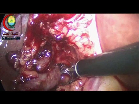 La disección del ganglio linfático Porta Hepatis puede necesitar un cirujano más delicado que yo